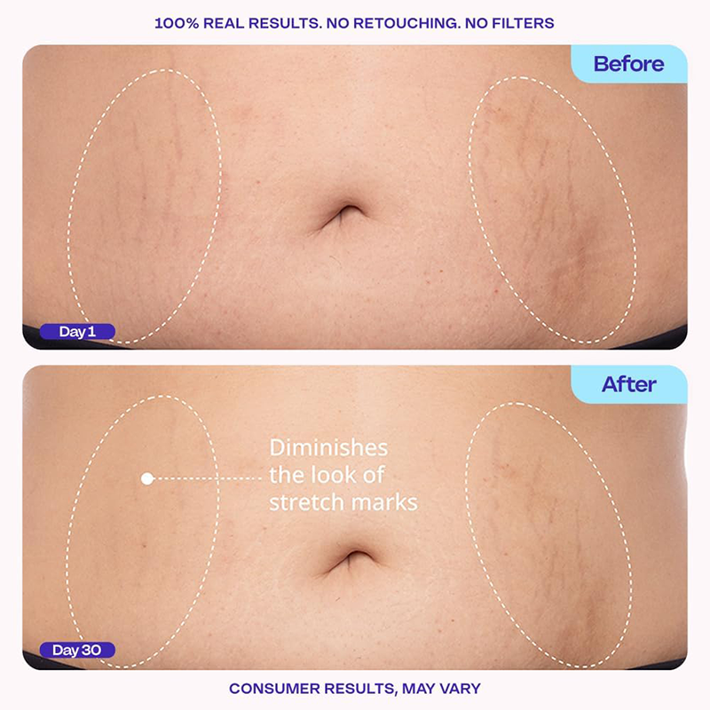 Tighten & Smooth Belly Cream, MicroTight4 Complex Body Firming Lotion for Loose Skin💜