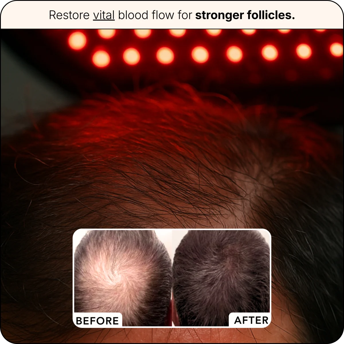 LED Scalp Therapy Hat For Hair Regrowth Free Ship🧢